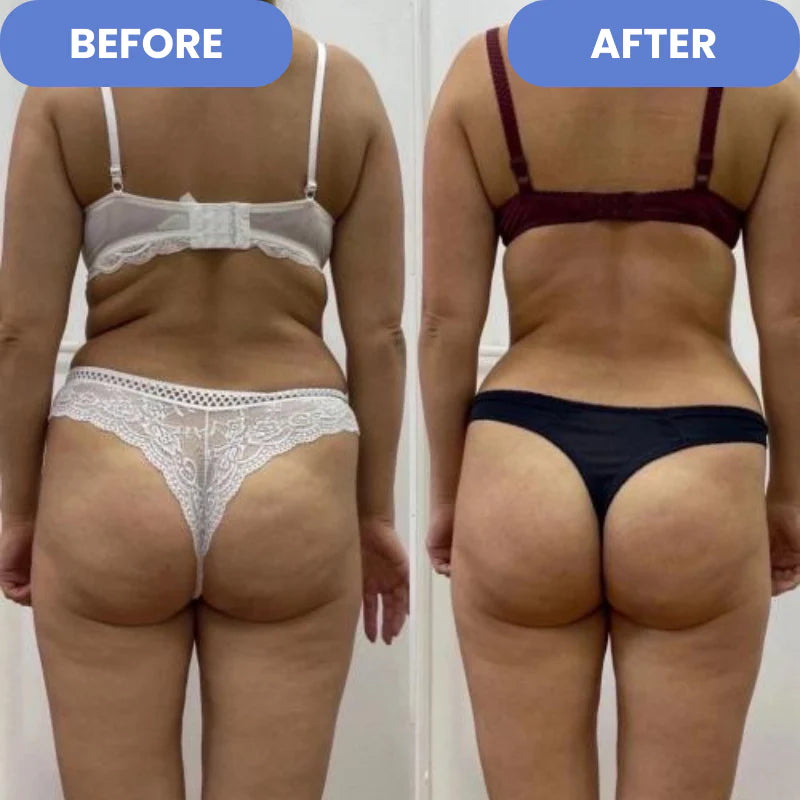 SculptEase - Traitement anti-cellulite 4 en 1